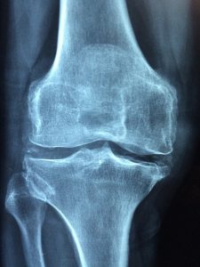 Facteurs de risque d'ostéoporose que les femmes dans la vingtaine doivent connaître